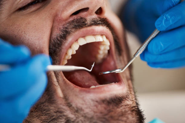 Best Dental Abscess Treatment in Gadsden, AL